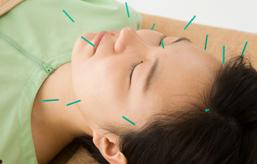 Manfaat akupunktur wajah